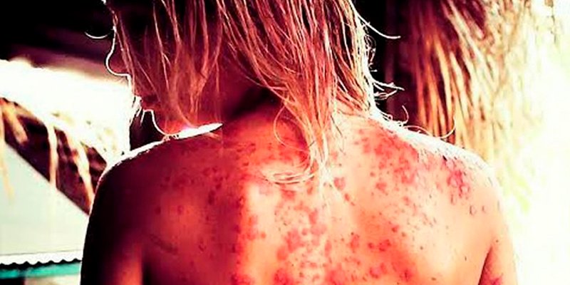 Nuevo tratamiento de la psoriasis por medio de la flora intestinal