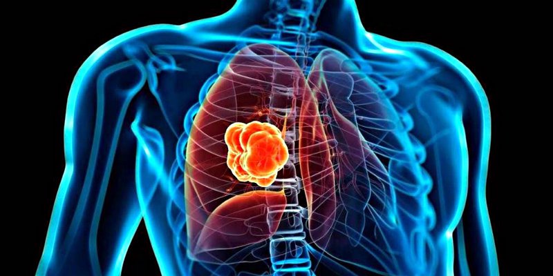 Así es la nueva terapia común contra el cáncer que puede ser eficaz para un tumor de pulmón no tratable
