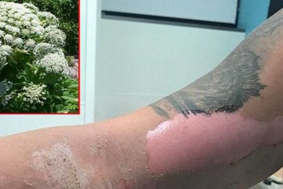 Heridas causadas al adolescente de Virginia por el perejil gigante