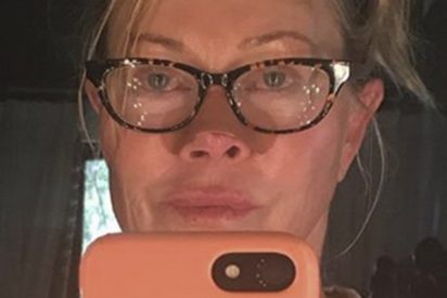 Melanie Griffith ense&ntilde;a el efecto del c&aacute;ncer de piel en su propia nariz