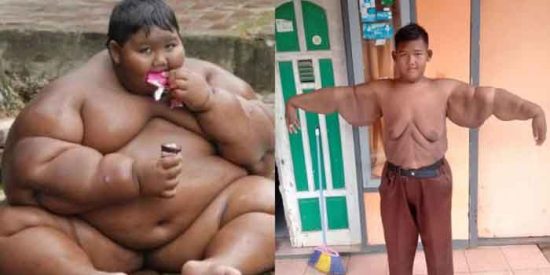 Arya Permana: La impresionante transformaci&oacute;n del 'ni&ntilde;o m&aacute;s obeso del mundo'