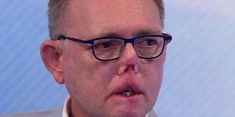 “Perdí las piernas, los dedos y parte de la cara por un arañazo y un lametón de mi perro”