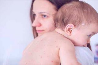 &iquest;Sab&iacute;as que el sarampi&oacute;n puede da&ntilde;ar las defensas de un ni&ntilde;o contra otras infecciones graves?