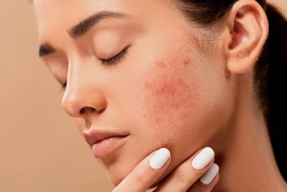 Piel: elimina los peque&ntilde;os granos de la cara con estos superalimentos