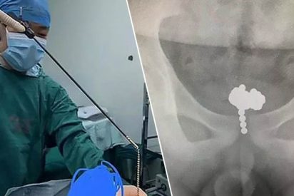 Ni&ntilde;o introduce 70 bolas magn&eacute;ticas en su pene para jugar y termina en el quir&oacute;fano