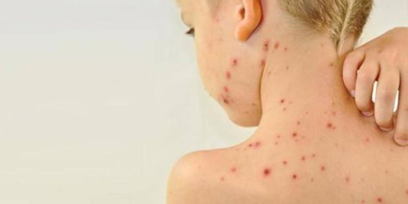 Un ni&ntilde;o franc&eacute;s sin vacunar reintrodujo el sarampi&oacute;n en Costa Rica