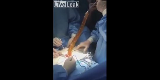 Cirujanos extraen un enorme consolador del est&oacute;mago de una mujer