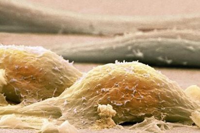 Todo lo que debes saber sobre el Sarcoma: ese bultito raro que aparece de repente