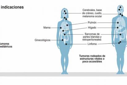 La protonterapia produce menos efectos secundarios que la radioterapia tradicional