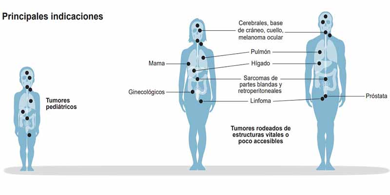La protonterapia produce menos efectos secundarios que la radioterapia tradicional