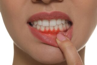 Enfermedades de los dientes y enc&iacute;as est&aacute;n asociadas a un mayor riesgo de c&aacute;ncer de h&iacute;gado