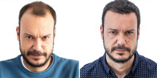 &iquest;Compensa viajar a Turqu&iacute;a a injertarse pelo?