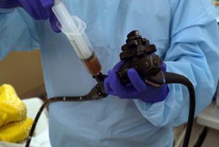 Muere un paciente por un trasplante fecal que conten&iacute;a una bacteria resistente a los medicamentos