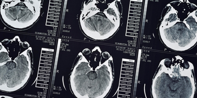 Descubre que una enorme tenia se aloj&oacute; en su cerebro durante un a&ntilde;o