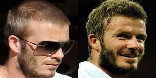 &iquest;Cu&aacute;ntas semanas tienen que pasar para que no se note que me he hecho un injerto de pelo?