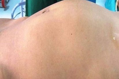 Una chica con un bulto en el abdomen acude al m&eacute;dico y descubren que era el feto malformado de su gemelo