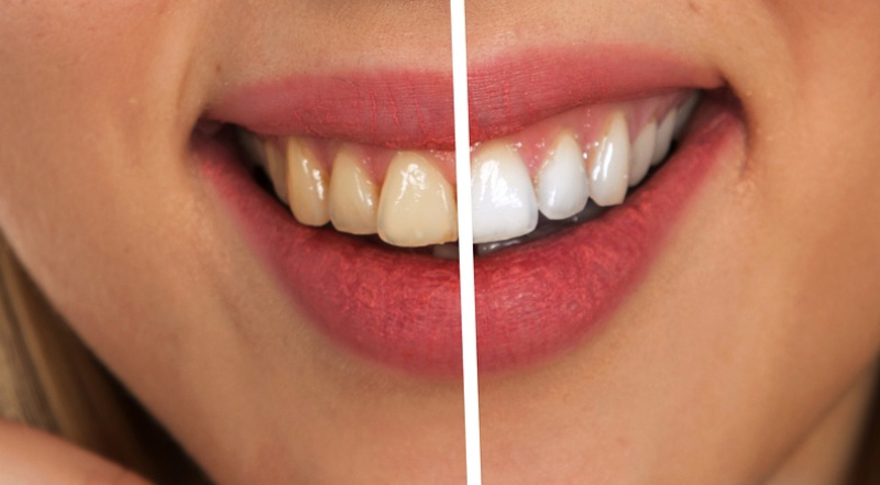 Dientes: 7 consejos para conseguir una sonrisa blanca y perfecta