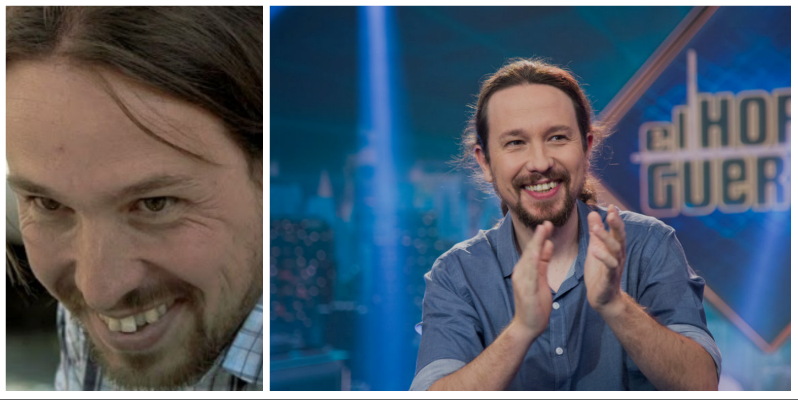 Pablo Iglesias le hinca el diente al cierre de campa&ntilde;a electoral estrenando su caro tratamiento dental