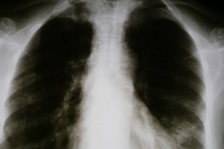 Google logra ense&ntilde;ar a la IA a diagnosticar condiciones pulmonares con la precisi&oacute;n de un m&eacute;dico especialista humano