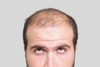 Calvicie: Los genes que predicen la alopecia