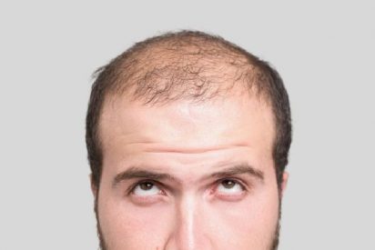 Calvicie: Los genes que predicen la alopecia
