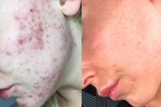 Una doctora halla el tratamiento definitivo contra el acn&eacute; y sus marcas