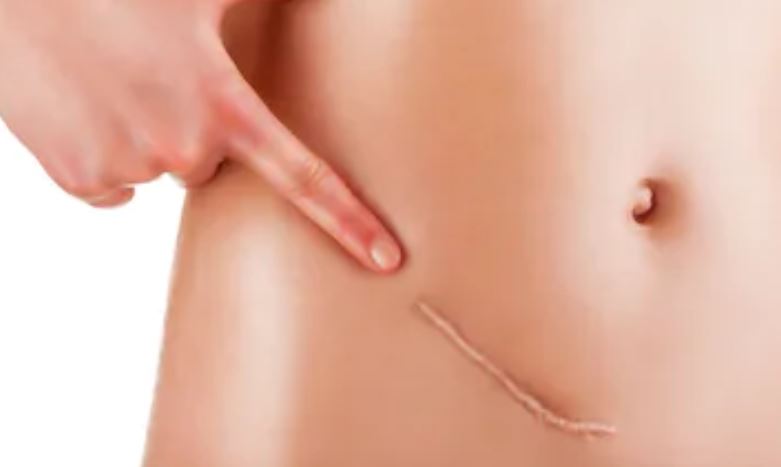 los parches reductores de cicatrices