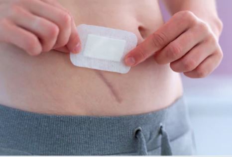 Cómo funcionan los parches reductores de cicatrices