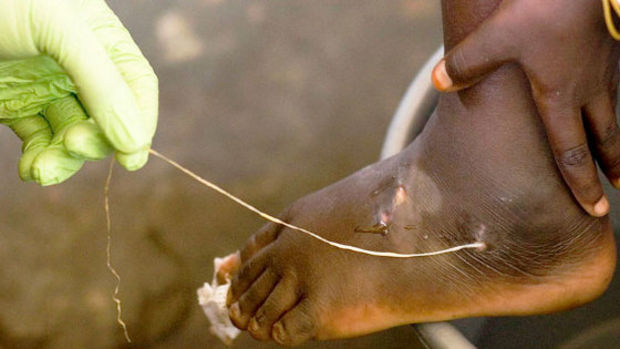 &iquest;Nueva crisis sanitaria?: &lsquo;resucita&rsquo; en Vietnam un extra&ntilde;o par&aacute;sito que se aloja en el cuerpo humano