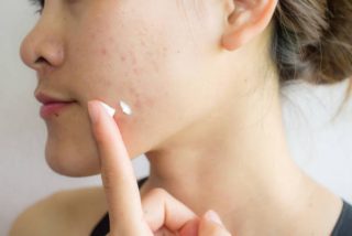 &iquest;Funciona la pasta de dientes para las espinillas?