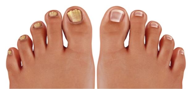 uñas amarillas remedios