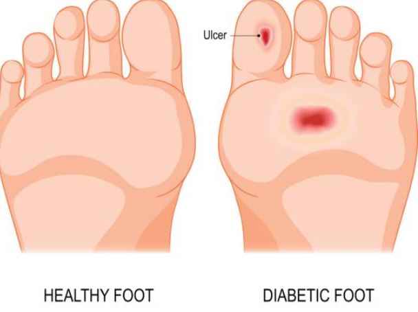 ùlceras pie diabeetico