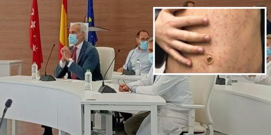 Viruela del mono en Madrid: 75 casos confirmados y se investigan otros 46