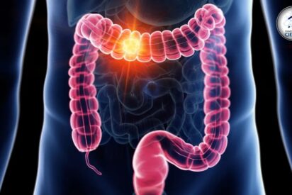 Cáncer de colon