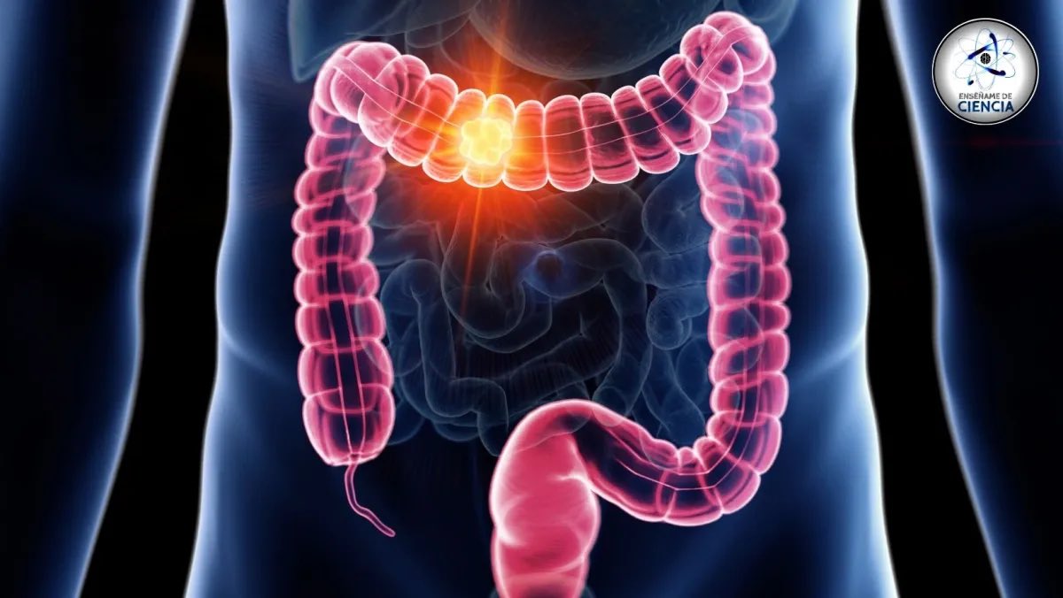 Cáncer de colon