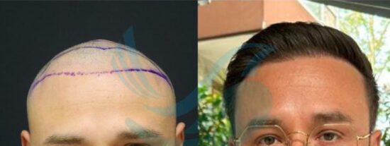 trasplante capilar en Turquía