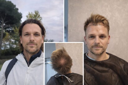 Tratamiento capilar en Turqu&iacute;a