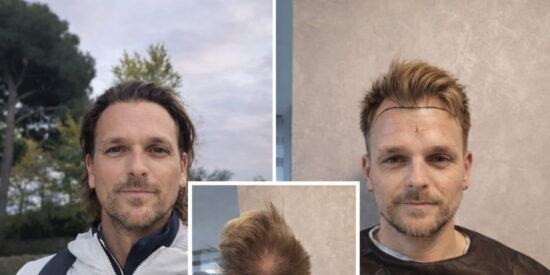 Tratamiento capilar en Turqu&iacute;a