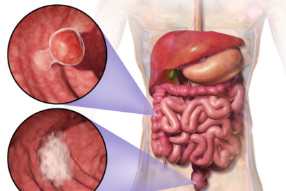 El enemigo invisible que no duele: as&iacute; avanza el c&aacute;ncer de pr&oacute;stata sin dar la cara