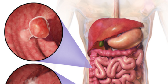 El enemigo invisible que no duele: as&iacute; avanza el c&aacute;ncer de pr&oacute;stata sin dar la cara