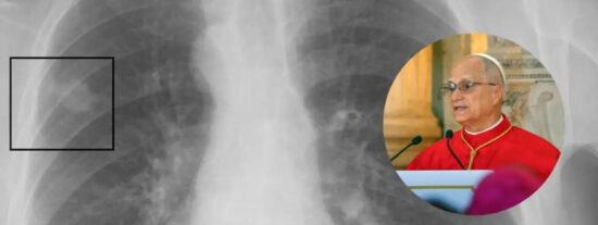 El papa Le&oacute;n XIV se someter&aacute; a una operaci&oacute;n para extirpar un n&oacute;dulo pulmonar detectado en una fase temprana